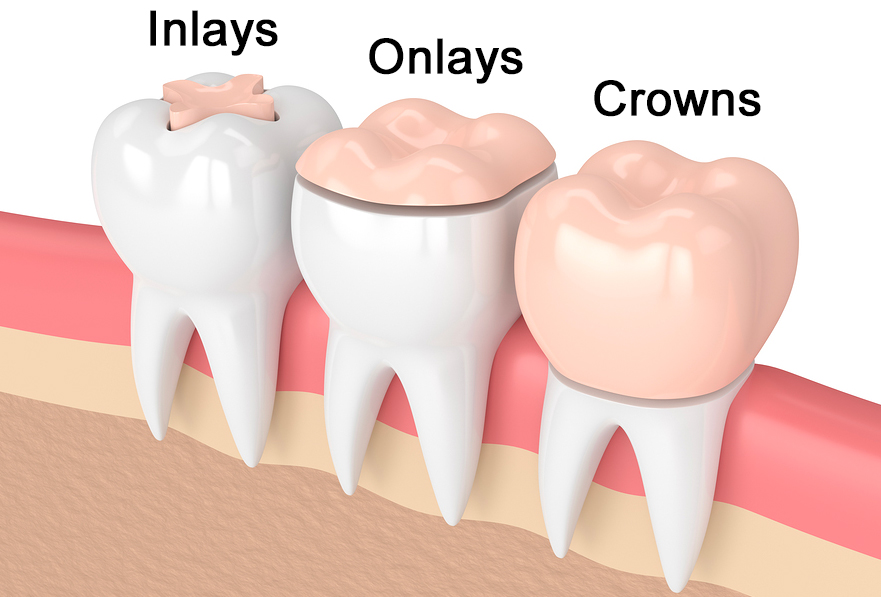 dental inlays and onlays