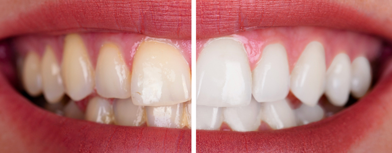 tooth whitening